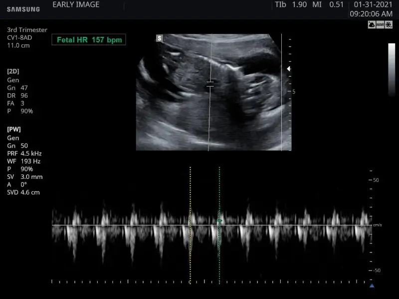 Check baby’s hearbeat